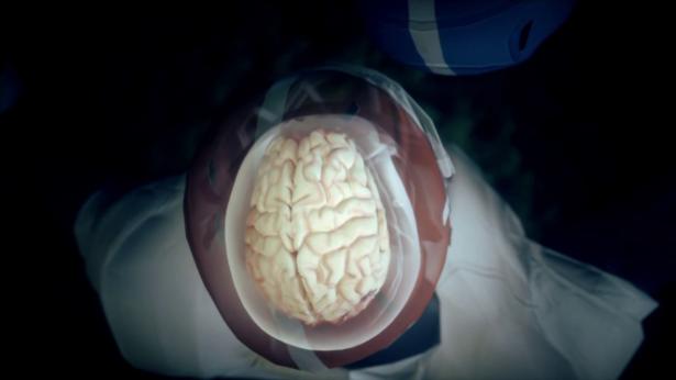 League of Denial: How CTE Affects the Brain